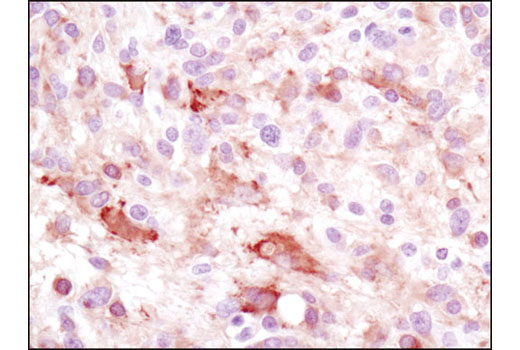 Immunohistochemical analysis of paraffin-embedded human glioblastoma multiforme using LC3A (D50G8) XP ® Rabbit mAb.