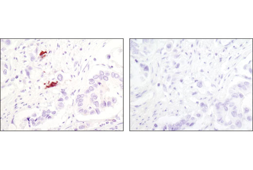 Immunohistochemical analysis of paraffin-embedded human colon carcinoma using LC3A (D50G8) XP ® Rabbit mAb (left) or