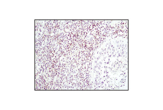 Immunohistochemical analysis of paraffin-embedded human lung carcinoma using Lck (D88) XP ® Rabbit mAb.