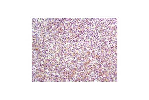 Immunohistochemical analysis of paraffin-embedded human lymphoma using Lck (D88) XP ® Rabbit mAb.
