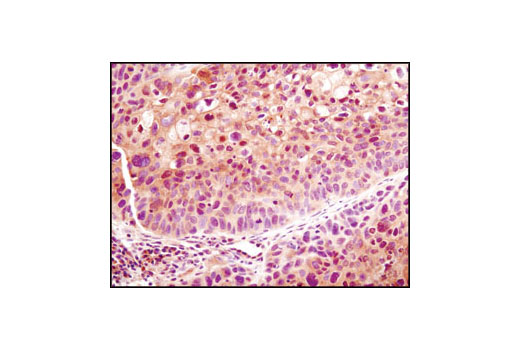 Immunohistochemical analysis of paraffin-embedded human lung carcinoma using LDHA (C4B5) Rabbit mAb.