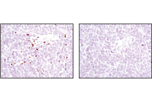 Immunohistochemical analysis of paraffin-embedded non-Hodgkin's lymphoma, using 5-Lipoxygenase (C49G1) Rabbit mAb in the presence of control peptide (left) or antigen specific peptide (right).