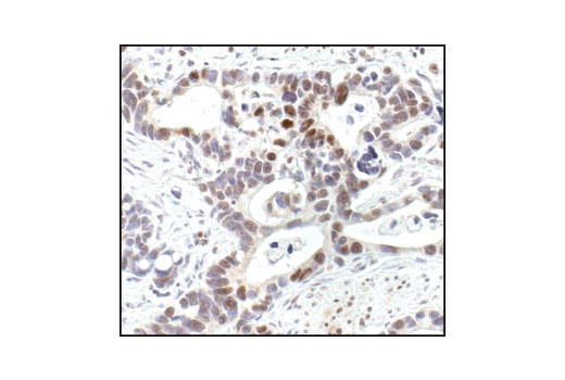 Immunohistochemical analysis of paraffin-embedded human colon carcinoma using Acetylated-Lysine Antibody.