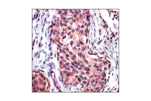 Immunohistochemical staining of a paraffin-embedded human breast tumor section showing nuclear and cytoplasmic localization of proteins with acetylated lysine residues using Acetylated-Lysine Antibody.