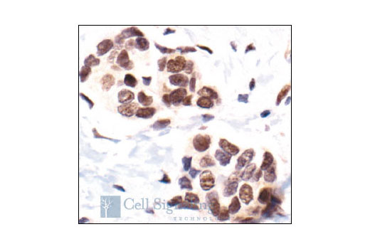 Immunohistochemical analysis of paraffin-embedded human breast carcinoma showing, nuclear localization, using Phospho-MAPKAPK-2 (Thr334) Antibody.
