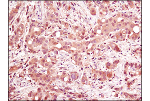 Immunohistochemical analysis of paraffin-embedded human breast carcinoma using p38 MAPK (D13E1) XP ® Rabbit mAb.