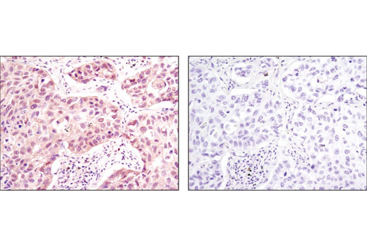 Immunohistochemical analysis of paraffin-embedded human lung carcinoma using p38 MAPK (D13E1) XP ® Rabbit mAb in the presence of control peptide (left) or antigen-specific peptide (right).