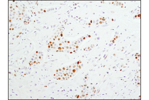 Immunohistochemical analysis of paraffin-embedded human breast carcinoma using MCM4 (D3H6N) XP® Rabbit mAb.