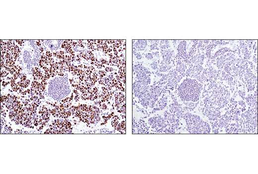 Immunohistochemical analysis of paraffin-embedded human lung carcinoma using MCM4 (D3H6N) XP® Rabbit mAb in the presence of control peptide (left) or antigen-specific peptide (right).