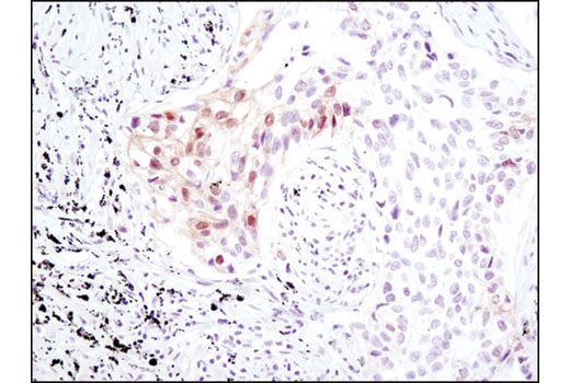 Immunohistochemical analysis of paraffin-embedded human lung carcinoma using Phospho-MOB1 (Thr35) (D2F10) Rabbit mAb.