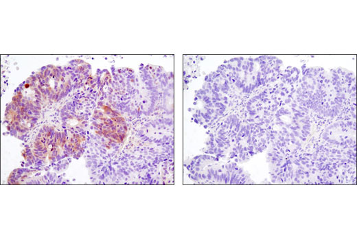 Immunohistochemical analysis of paraffin-embedded human ovarian carcinoma control (left) or lambda phosphatase-treated (right) using Phospho-MOB1 (Thr35) (D2F10) Rabbit mAb.