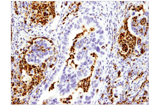 Immunohistochemical analysis of paraffin-embedded colon adenocarcinoma using Myeloperoxidase (E1E7I) XP ® Rabbit mAb.