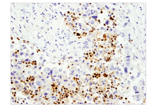 Immunohistochemical analysis of paraffin-embedded non-small cell lung carcinoma using Myeloperoxidase (E1E7I) XP ® Rabbit mAb.