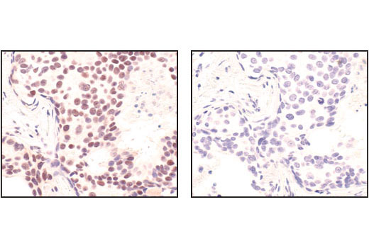 Immunohistochemical analysis of paraffin-embedded human breast carcinoma, using Mre11 (31H4) Rabbit mAb in the presence of control peptide (left) or Mre11 Blocking Peptide #1035 (right).