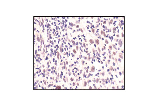 Immunohistochemical analysis of paraffin-embedded lung carcinoma, using Mre11 (31H4) Rabbit mAb.