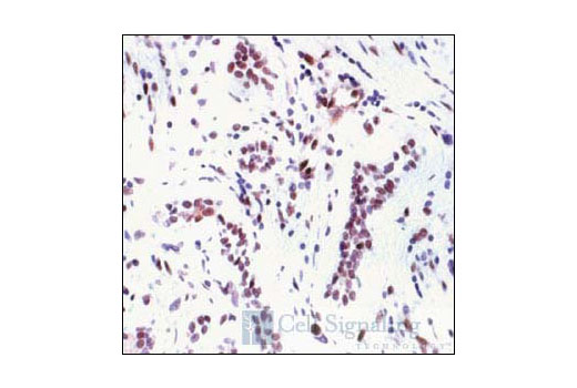 Immunohistochemical analysis of paraffin-embedded human breast carcinoma, showing nuclear localization, using Phospho-MSK1 (Thr581) Antibody.