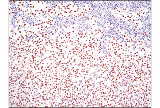 Immunohistochemical analysis of paraffin-embedded human seminoma using Nanog (D73G4) XP ® Rabbit mAb.