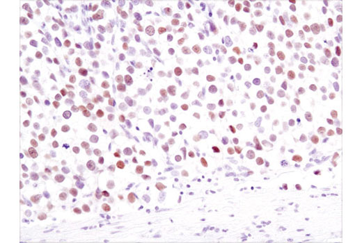 Immunohistochemical analysis of paraffin-embedded human seminoma using Nanog (1E6C4) Mouse mAb.