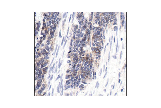 Immunohistochemical analysis of paraffin-embedded human neuroblastoma, using NCAM (CD56) (123C3) Mouse mAb.