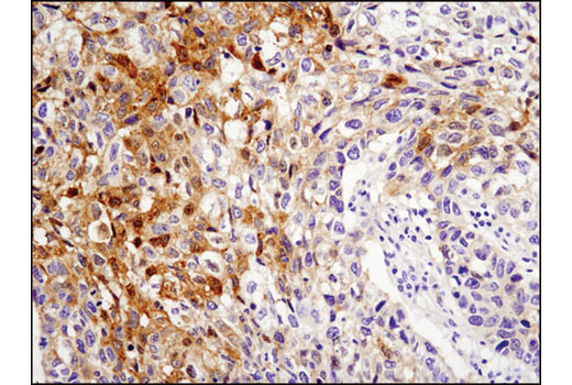 Immunohistichemical analysis of paraffin-embedded human lung carcinoma using NDRG4 (D4A6) Rabbit mAb.