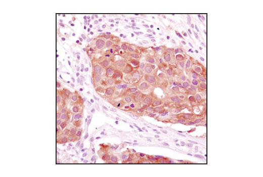 Immunohistochemical analysis of paraffin-embedded human breast carcinoma using NME1/NDKA (D98) Antibody.