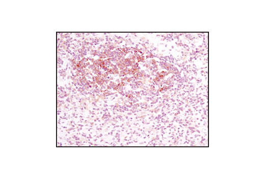 Immunohistochemical analysis of paraffin-embedded human lymphoma using NME1/NDKA (D98) Antibody.