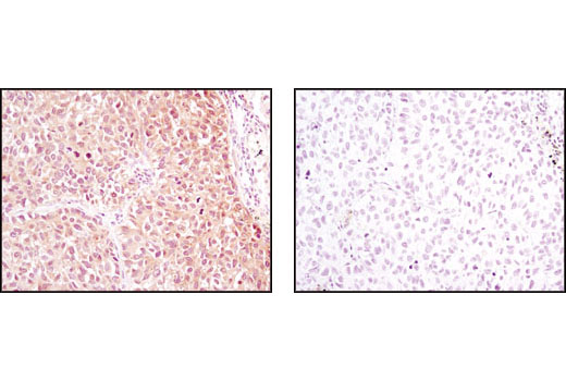 Immunohistochemical analysis of paraffin-embedded human lung carcinoma using NME1/NDKA (D98) Antibody in the presence of control peptide (left) or antigen-specific peptide (right).