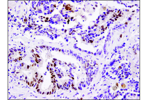 Immunohistochemical analysis of paraffin-embedded human lung carcinoma using DAX1 (D2F1) Rabbit mAb.