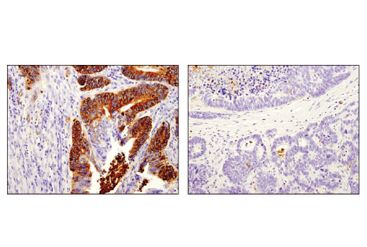 Immunohistochemical analysis of paraffin-embedded human colon carcinoma, stage I (left) and stage IV (right) using OLFM4 (D1E4M) XP ® Rabbit mAb. Note the stronger expression in the tumor of the stage I case compared to the stage IV case.
