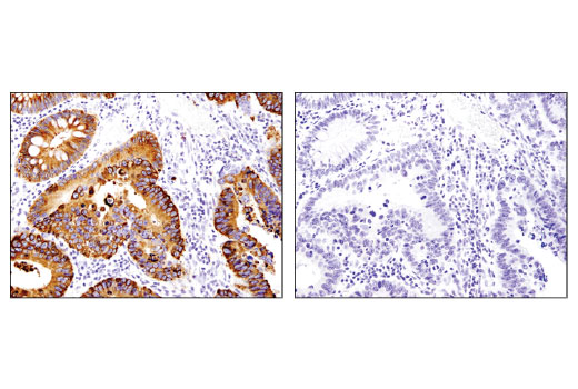 Immunohistochemical analysis of paraffin-embedded human colon carcinoma using OLFM4 (D1E4M) XP ® Rabbit mAb in the presence of control peptide (left) or antigen-specific peptide (right).