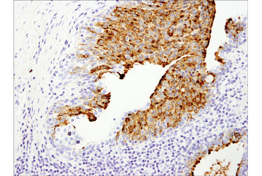 Immunohistochemical analysis of paraffin-embedded human prostate adenocarcinoma using OLFM4 (D1E4M) XP ® Rabbit mAb.