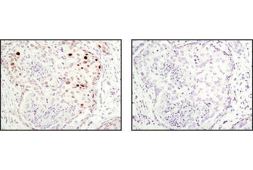 Immunohistochemical analysis of paraffin-embedded human breast carcinoma using p21 Waf1/Cip1 (12D1) Rabbit mAb in the presence of control peptide (left) or antigen-specific peptide (right).