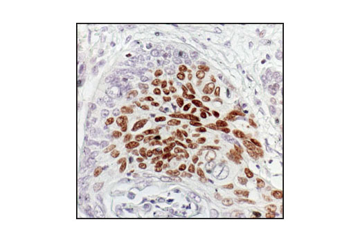 Immunohistochemical analysis of paraffin-embedded human squamous cell carcinoma of the esophagus, showing nuclear localization, using Phospho-p63 (Ser160/162) Antibody.