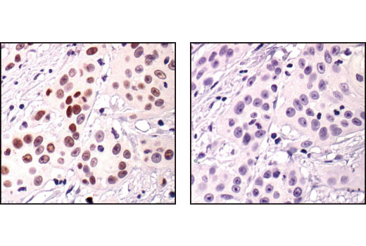 Immunohistochemical analysis of paraffin-embedded human squamous cell carcinoma, using Phospho-p63 (Ser160/162) Antibody in the presence of control peptide (left) or antigen-specific peptide (right).