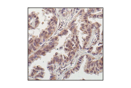 Immunohistochemical analysis of paraffin-embedded human lung carcinoma, showing cytoplasmic and nuclear localization, using p70 S6 Kinase (49D7) Rabbit mAb.