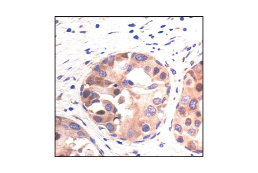 Immunohistochemical analysis of paraffin-embedded human breast carcinoma, using PABP1 Antibody.