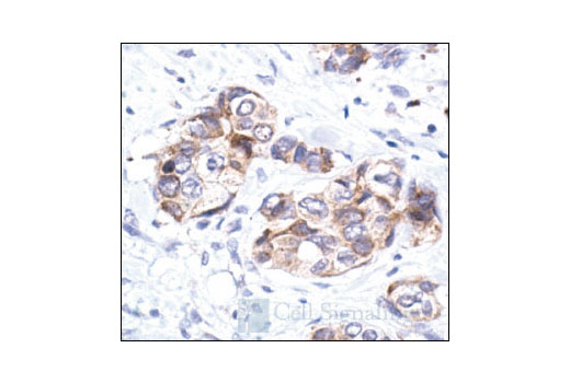 Immunohistochemical analysis of paraffin-embedded human breast carcinoma, showing cytoplasmic localization, using PAK1 Antibody.