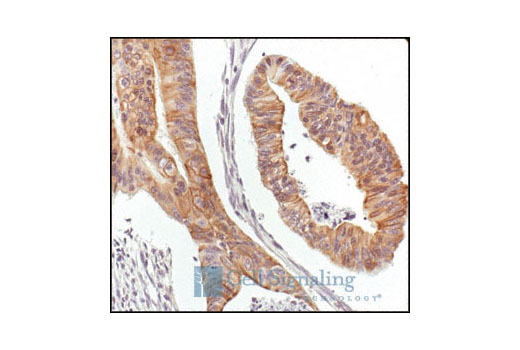 Immunohistochemical analysis of paraffin-embedded human colon carcinoma, showing membrane and cytoplasmic localization, using PBK/TOPK Antibody.