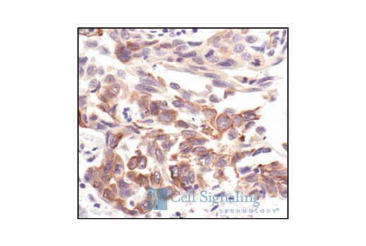 Immunohistochemical analysis of paraffin-embedded human lung carcinoma, using PBK/TOPK Antibody.