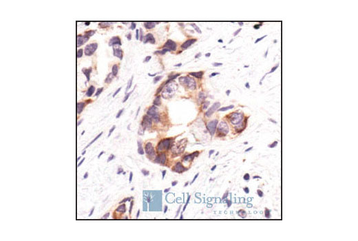 Immunohistochemical analysis of paraffin-embedded human prostate carcinoma, using PBK/TOPK Antibody.