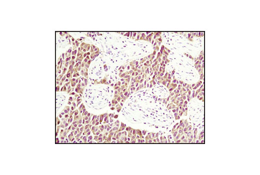 Immunohistochemical analysis of paraffin-embedded human breast carcinoma using PDCD4 (D29C6) XP ® Rabbit mAb.
