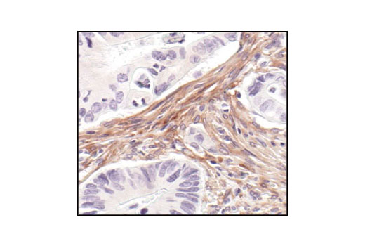 Immunohistochemical analysis of paraffin-embedded human colon carcinoma using PDGF Receptor β (28E1) Rabbit mAb.
