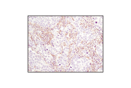 Immunohistochemical analysis of paraffin-embedded human lung carcinoma using PDGF Receptor β (C82A3) Rabbit mAb.