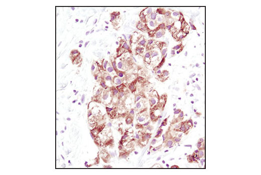 Immunohistochemical analysis of paraffin-embedded human breast carcinoma using PDI Antibody.