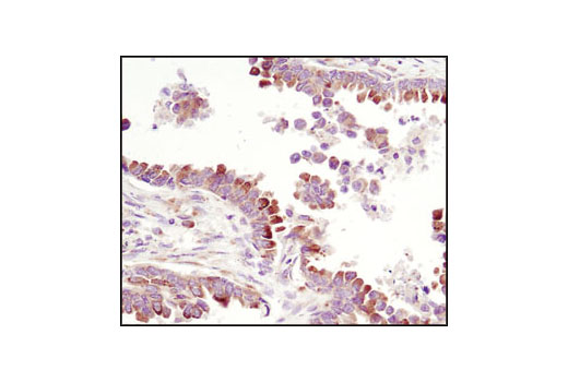Immunohistochemical analysis of paraffin-embedded human lung carcinoma using PDI Antibody.