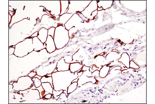 Immunohistochemical analysis of paraffin-embedded breast carcinoma using Perilipin (D1D8) XP ® Rabbit mAb. Note specific staining of adipocytes.