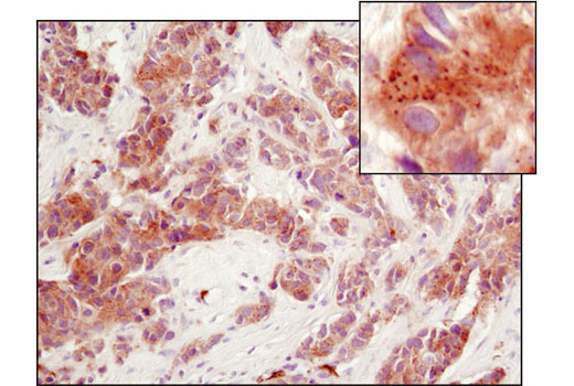 Immunohistochemical analysis of paraffin-embedded human breast carcinoma using PERK (D11A8) Rabbit mAb.
