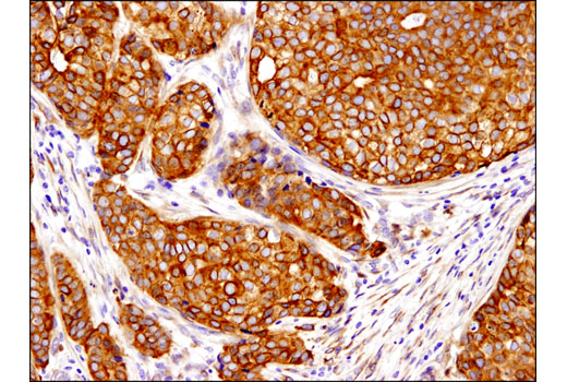 Immunohistochemical analysis of paraffin-embedded human breast adenocarcinoma using PGRMC1 (D6M5M) XP ® Rabbit mAb.