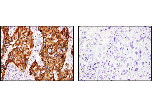 Immunohistochemical analysis of paraffin-embedded human lung non-small cell carcinoma using PGRMC1 (D6M5M) XP ® Rabbit mAb in the presence of control peptide (left) or antigen-specific peptide (right).