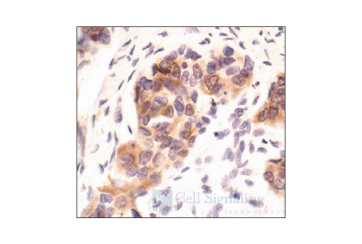 Immunohistochemical analysis of paraffin-embedded human breast carcinoma, using Phospho-PKCdelta/theta (Ser643/676) Antibody.